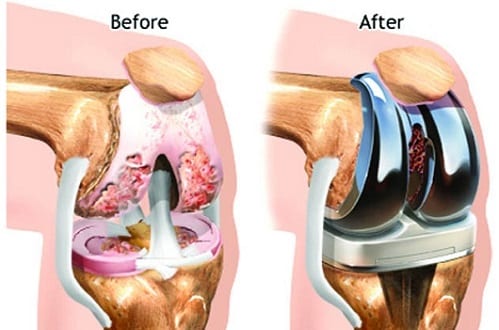 JOINT REPLACEMENT